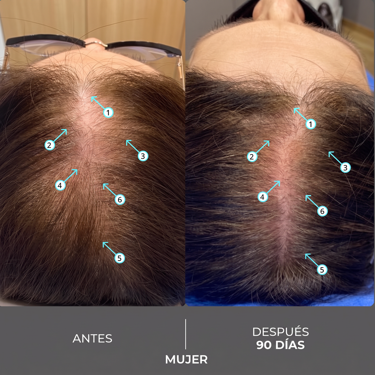 Shampoo Densificador Capilar Fuerza Extra con Nanoxidil 205ml
